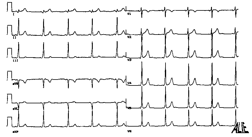 les anomalies de la conduction auriculo-ventriculaire 033A