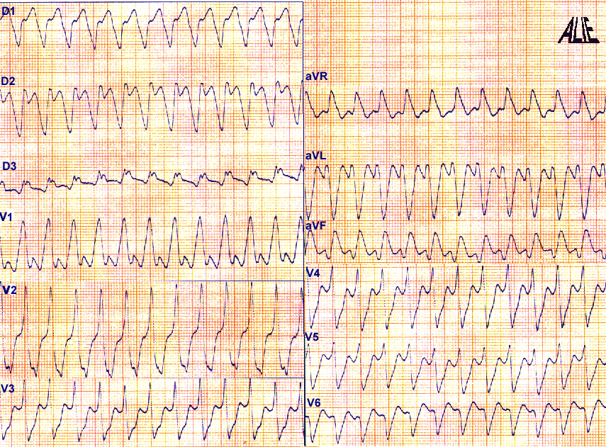 les anomalies ventriculaires 116A