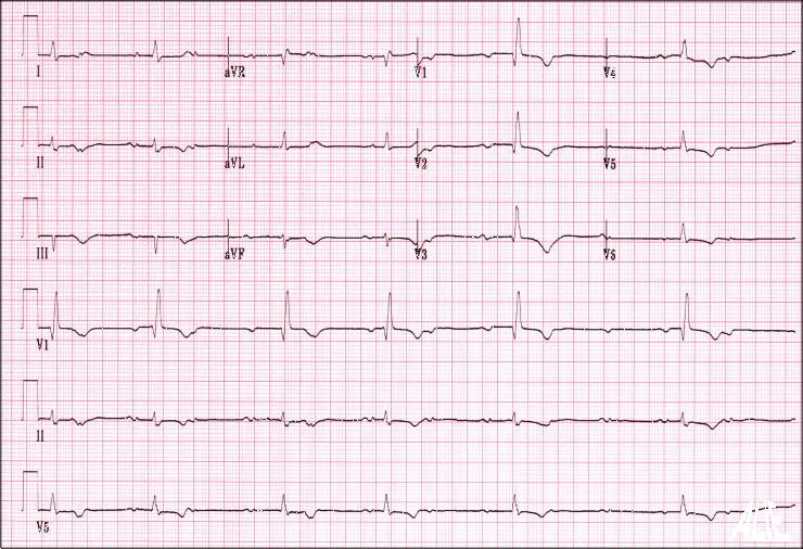 les anomalies de la conduction auriculo-ventriculaire 126A