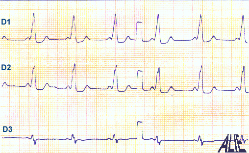 les anomalies de la conduction auriculo-ventriculaire 198A