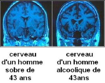 2) Les effets de l'alcool sur les alcooliques chroniques Cerveau1