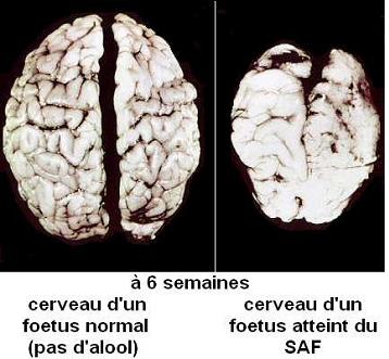 3) Les effets de l'alcool sur les foetus et jeunes enfants Cerveau2