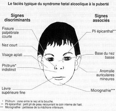 3) Les effets de l'alcool sur les foetus et jeunes enfants Tete1