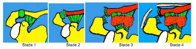 Diastasis acromio-claviculaire / Sub-luxation acromio-claviculaire Clavicule2