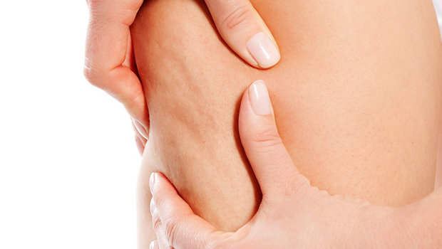 طرق التخلص من السيلوليت Header_image_Article_Main_Fustany_Bad_HabitsThat_Make_Cellulite_Worse