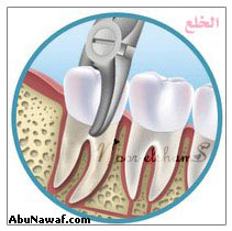 معلومات عن ضرس العقل 33