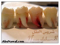 ضرس العقل بالصور"Wisdom Teeth" 34