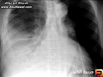 القذائف الرئويه Abonwaf5