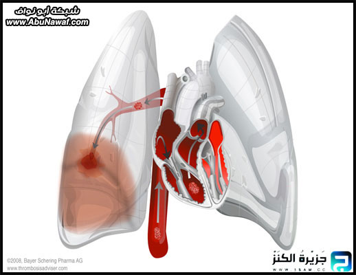 القذائف الرئويه Abonwaf6