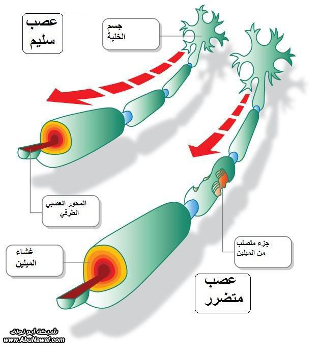 التصلب العصبي المتعدد  151