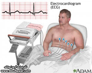 إنقلاب القلب Ecg