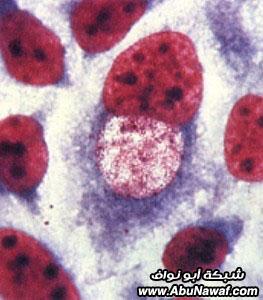  عاائلة الجراثيم!  Chlamydia