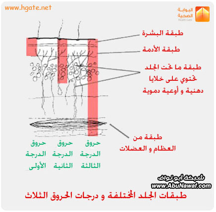 الحروق على اختلاف أنواعها وكيفية اسعافها Skinlayer