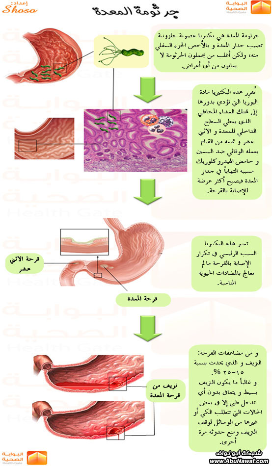 النظام الغذائى لمرضي قرحة المعدة  1