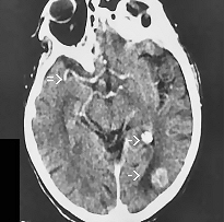 Métastase et cancer primaire Metastase