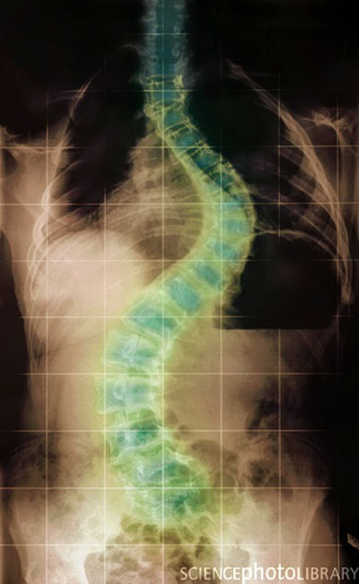  مرض متلازمة سوتو Soto's Syndrome  Soto_Syndrome%20(5)