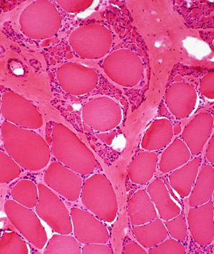 اسباب و علاج و معلومات عن الضمور العضلي الشوكي Spinal_Muscular_Atrophy