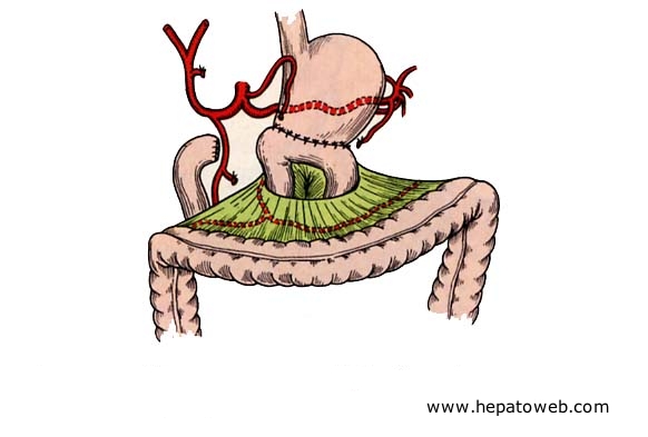 Estomac chirurgical (intervention et montage) Gastrectomiepolya