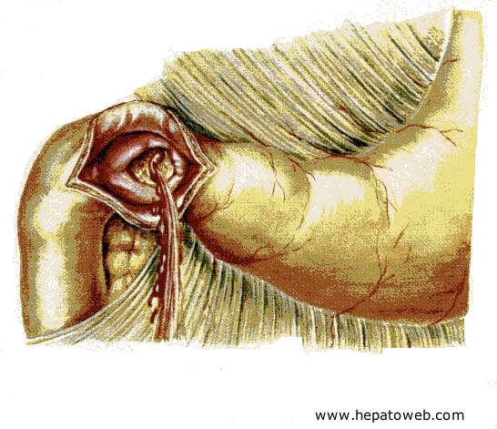 Estomac chirurgical (intervention et montage) Ulcerehemorragiqueduodenal