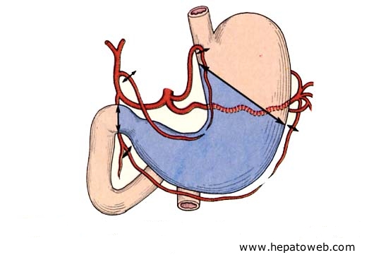 Estomac chirurgical (intervention et montage) Gastrectomie2tiers