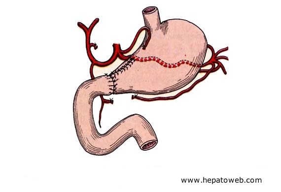 Estomac chirurgical (intervention et montage) Gastrectomiepean