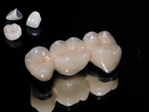 Răng sứ kim loại liệu có bền chặt như mọi người nói hay không? Rang-su-kim-loai-1