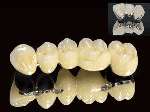 Răng sứ kim loại liệu có bền chặt như mọi người nói hay không? Rang-su-kim-loai-2