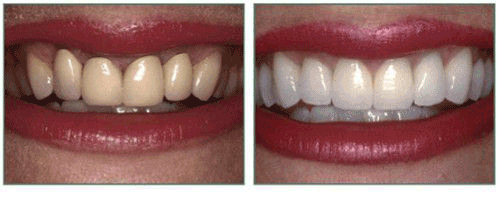 Răng sứ kim loại liệu có bền chặt như mọi người nói hay không? Rang-su-kim-loai-3