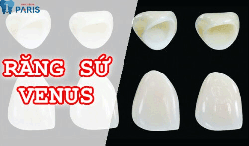 Trồng răng sứ venus có tốt bằng răng sứ crecon hay không? Rang-su-venus-1