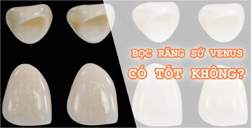 Trồng răng sứ venus có tốt bằng răng sứ crecon hay không? Rang-su-venus-2