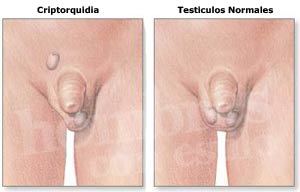 quiz virtual de histologia aparato reproducto rmasculino y femenio por MANULE GARCIAS SUAREZ COD: 102091125 Criptorquidia