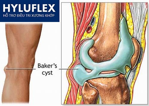 Sức khỏe, đời sống:  Bệnh tràn dịch khớp gối – Nguyên nhân và cách phòng tránh Benh-tran-dich-khop-goi-nguyen-nhan-va-cach-phong-tranh