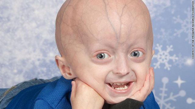 Wea random de "Know your meme". Pt. 1 T1larg.progeria