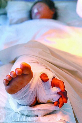 Surgeons Save Girl's Hand by Grafting It Onto Her Leg Article-1330947-0C21C6D0000005DC-62_224x335_popup