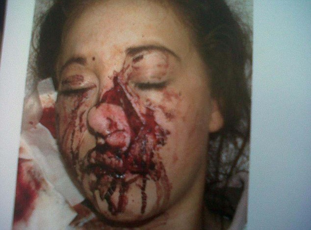 Teenager describes moment she was attacked by a dog that left her with horrific facial injuries Article-2317259-198E94EC000005DC-609_634x470