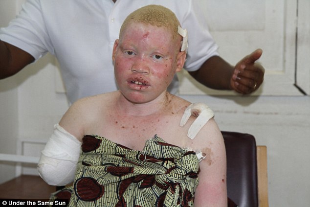 Les Albinos de plus en plus victimes d'attaques 2866AC0C00000578-3070662-image-a-6_1430986507081