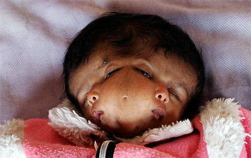 Villagers Worship Baby Born With 2 Faces in Liberia Two-facesx-large