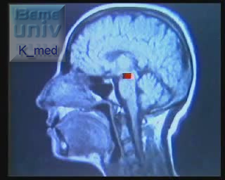 Vidéos examen neurologique: 4)Les nerfs craniens et les voies optiques 3-6