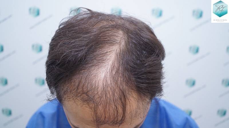 PAZIENTE 001 - 2500 GRAFTS FUE (10 e 11 OTTOBRE 2016) DSC09157_zps6n0axozi