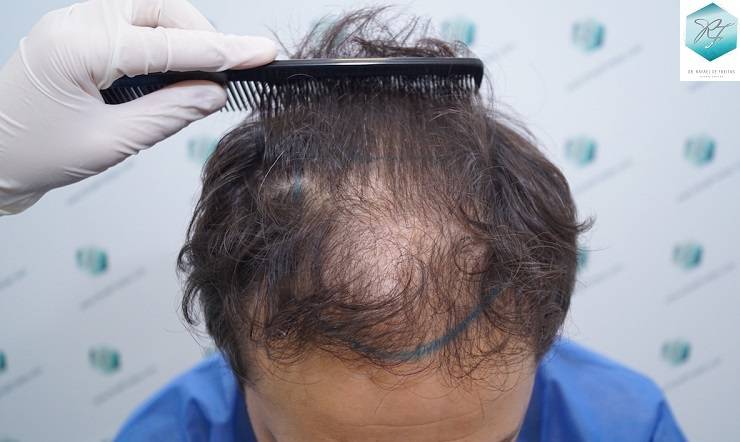 PAZIENTE 001 - 2500 GRAFTS FUE (10 e 11 OTTOBRE 2016) DSC09167_zpshrkjytkc