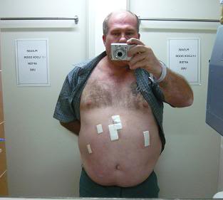 Owen's weight loss 5incisions-1