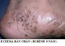 Bệnh Eczema - kết hợp đông tây y điều trị hiệu quả Eczema%20chun%201_1