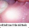 Tạo màng ngăn - phương pháp điều trị bệnh nhiệt miệng hiệu quả  Lomieng4_1