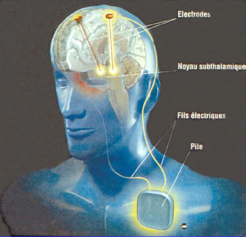 2012 : PUCES IMPLANTABLES, RFID, NANOTECHNOLOGIES, NEUROSCIENCES, N.B.I.C., TRANSHUMANISME  ET CYBERNETIQUE ! - Page 4 Stimulationcrbraleprofonde