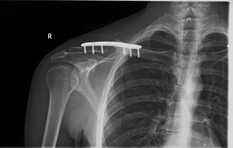 Clavicle Surgery X-Rays and Pictures X-RAYPLATER