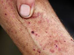 Bệnh Eczema - kết hợp đông tây y điều trị hiệu quả Diungximang2