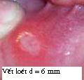Giới thiệu website về bệnh nhiệt miệng Lomieng3