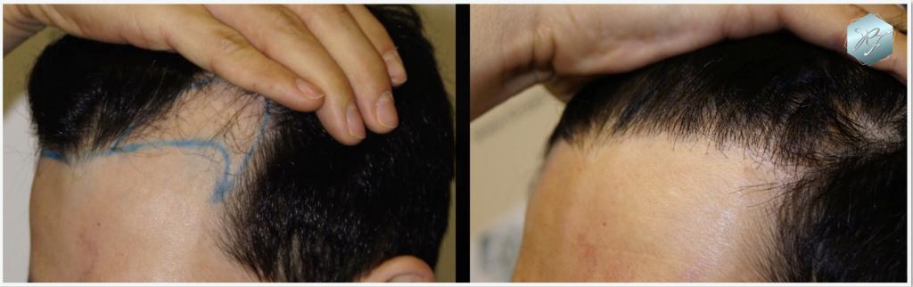 CLINICA DE FREITAS - 1645 GRAFTS FUE 220_zps38b8a7c0