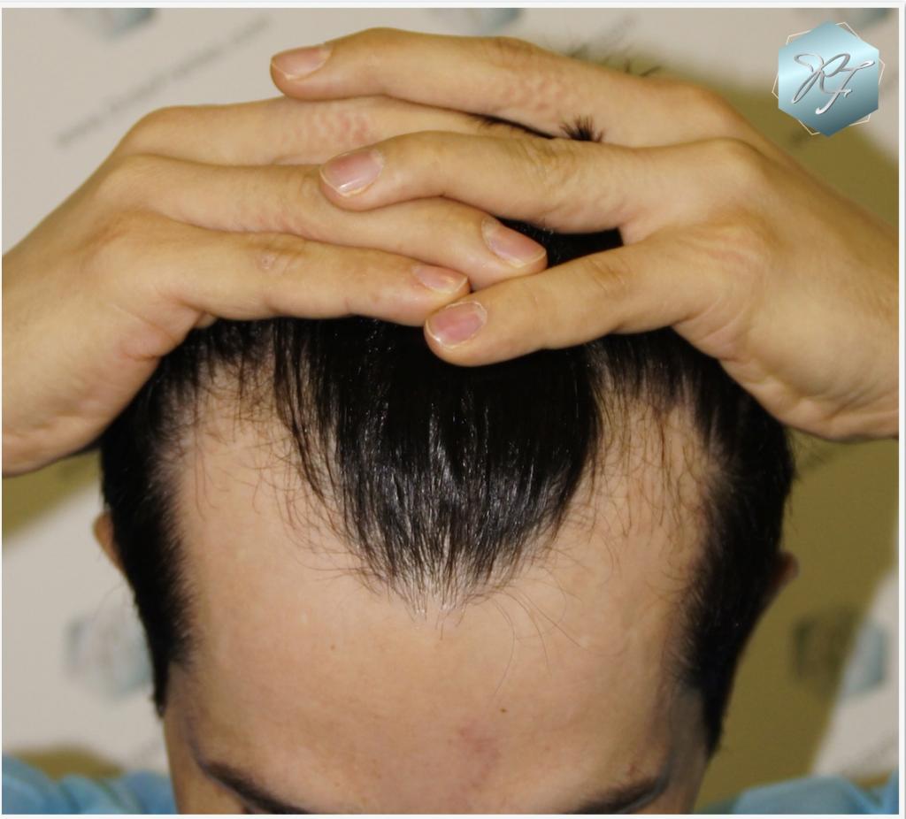 CLINICA DE FREITAS - 1645 GRAFTS FUE 22_zps88cafbe3