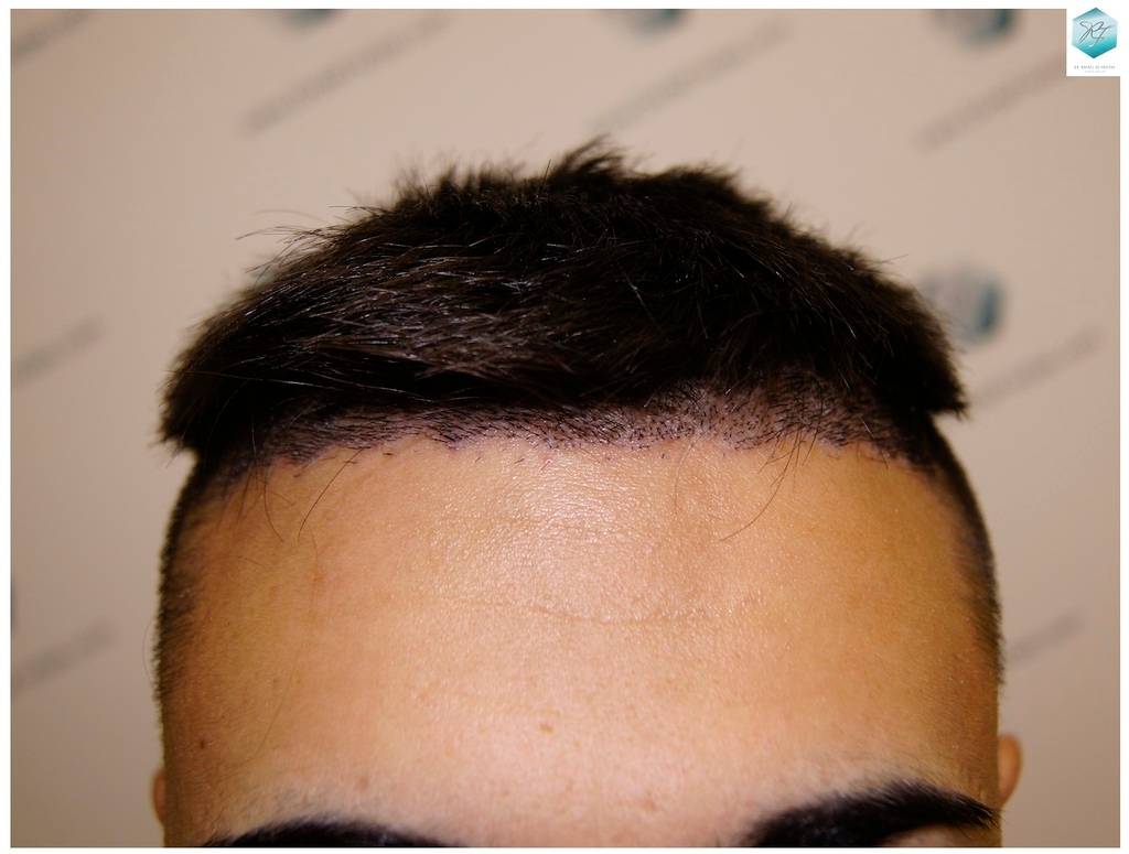 CLINICA DE FREITAS - 1683 GRAFTS FUE 11-En%209%20dias_zpstyedkfi5